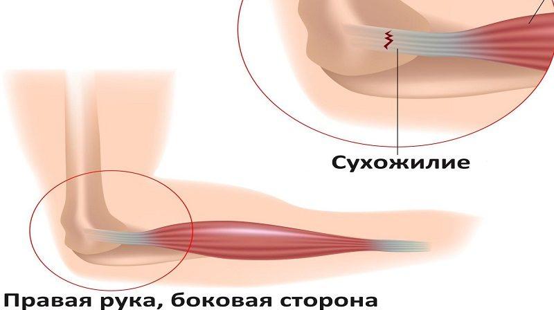 Как лечить растяжение связок локтевого сустава