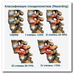 Как лечить спондилолистез поясничного отдела позвоночника