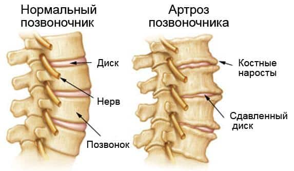 Как лечить артроз реберно-позвоночных суставов