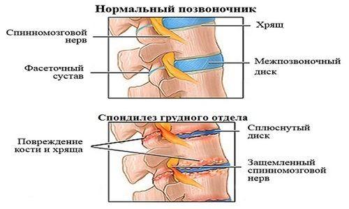Как лечить спондилез грудного отдела позвоночника