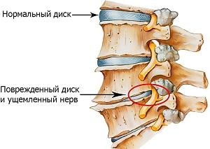 Как вылечить остеохондроз пояснично-крестцового отдела