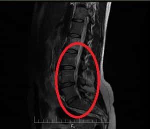 Как вылечить остеохондроз пояснично-крестцового отдела