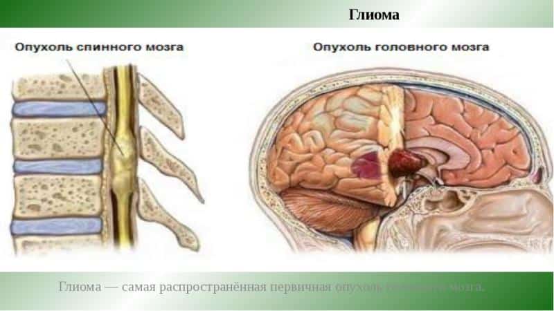 Как лечить рак спинного мозга