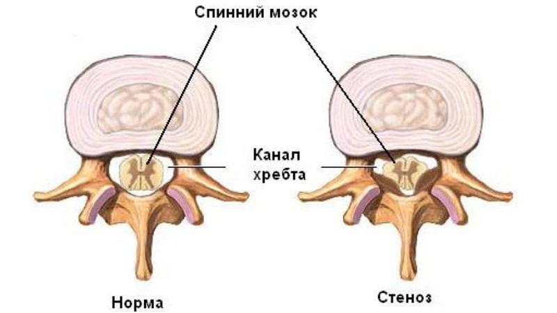 Как лечить стеноз позвоночного канала шейного отдела