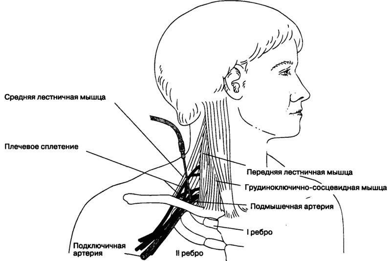 Как лечить синдром передней лестничной мышцы