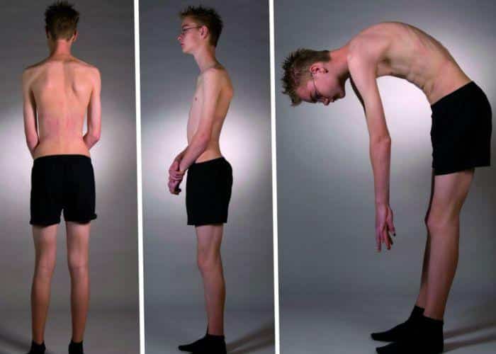 Как лечить кифоз грудного отдела позвоночника