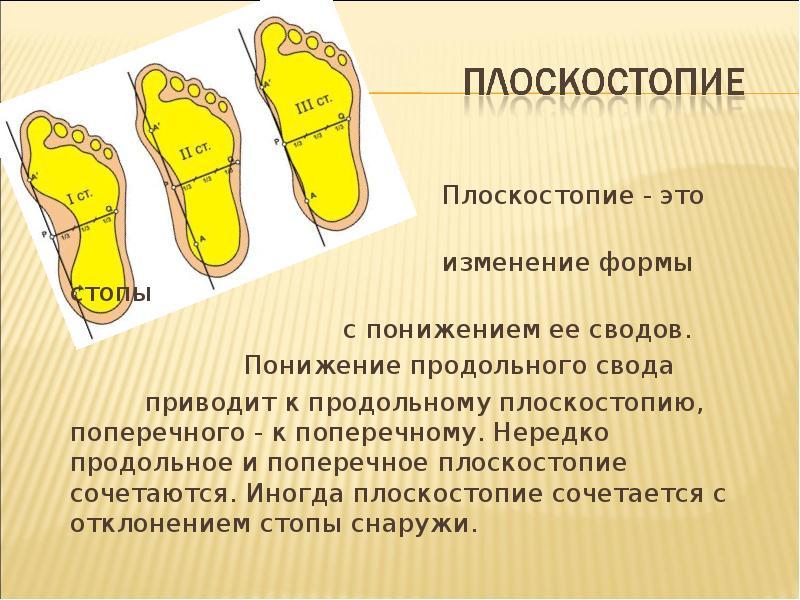 Гимнастика для стоп при плоскостопии у детей и взрослых