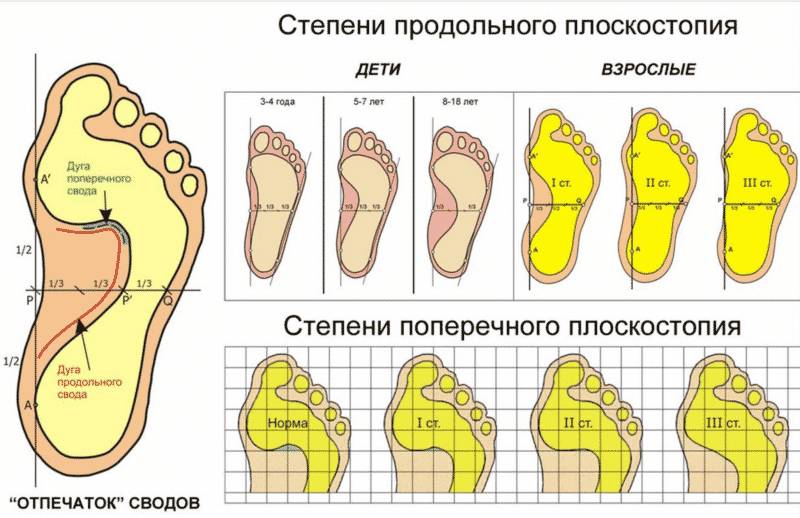 Гимнастика для стоп при плоскостопии у детей и взрослых