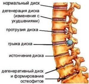 Как лечить спондилез шейного отдела позвоночника