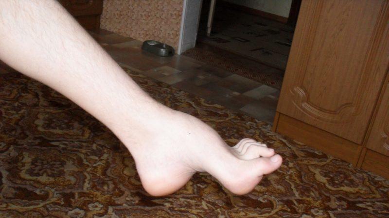 Что такое синдром Шарко и как его лечить