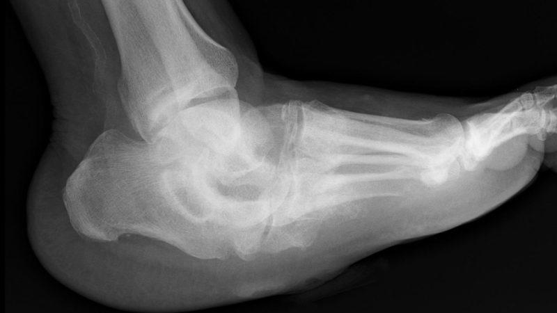 Что такое синдром Шарко и как его лечить