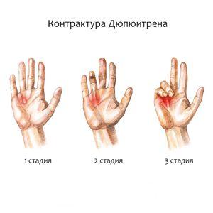 Как лечить синдром Дюпюитрена