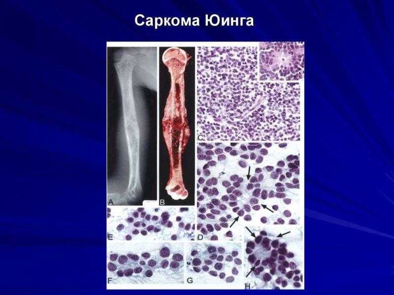 Что такое саркома Юинга