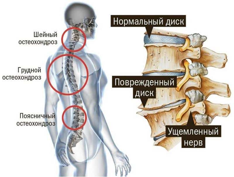 Как лечить остеохондроз при беременности