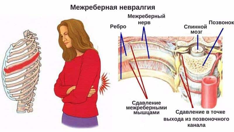 Как лечить межреберный хондроз