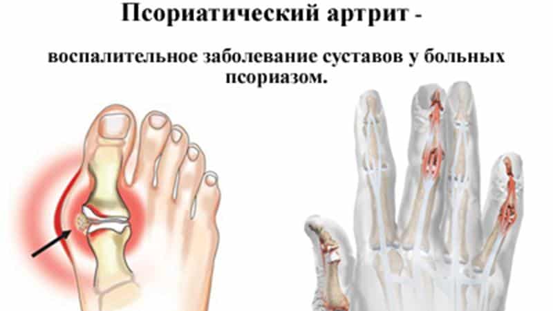 Какие бывают артриты