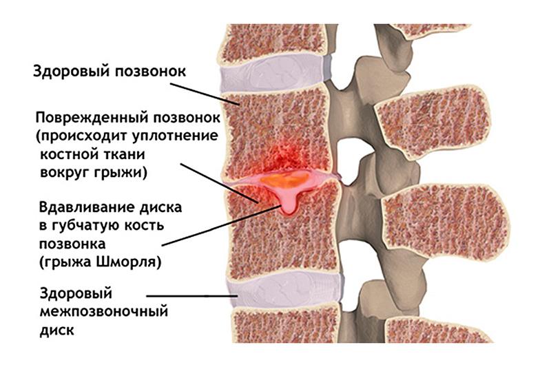 Как восстановить позвоночные диски