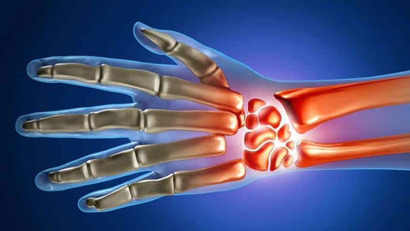 Как лечить воспаление и боль в лучезапястном суставе