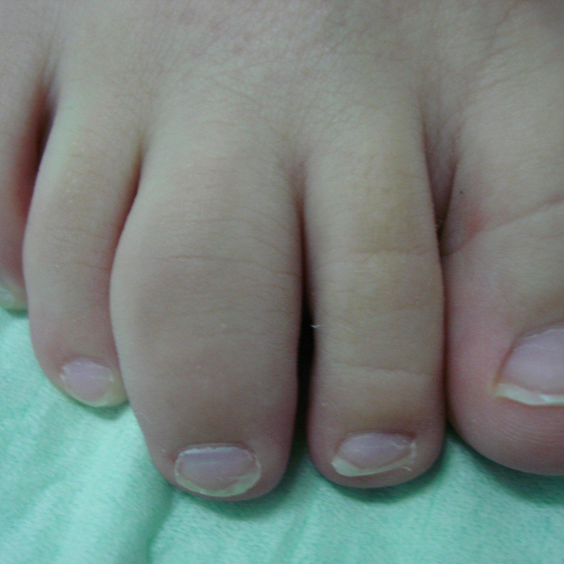 Как лечить ювенильный ревматоидный артрит