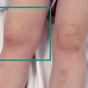 Как лечить ювенильный ревматоидный артрит