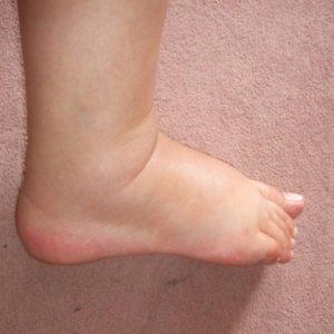 Как лечить ювенильный ревматоидный артрит