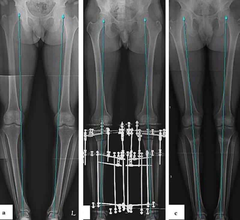 Как лечить варусную и вальгусную деформацию голеней