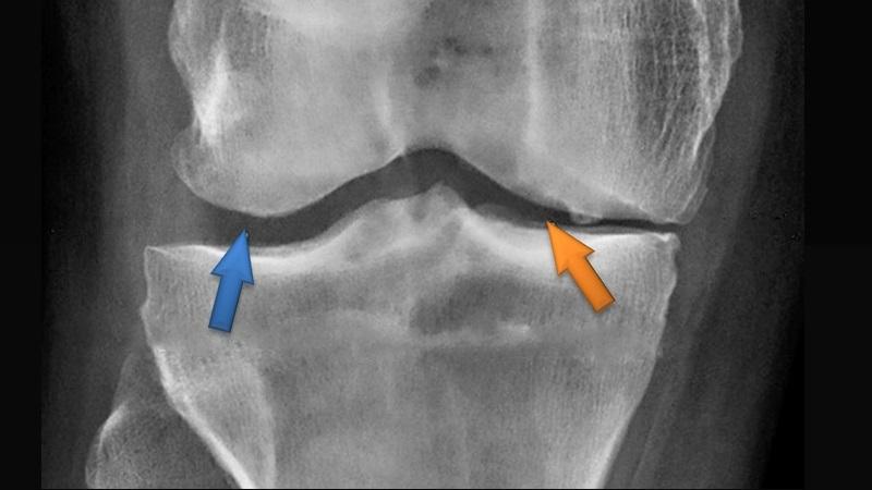Остеопороз коленного сустава - симптомы и лечение