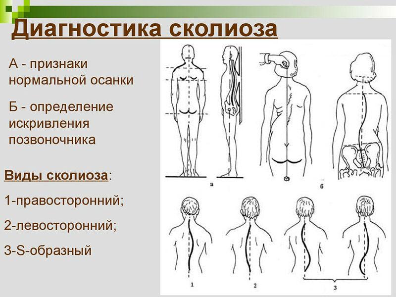 Какими видами спорта можно заниматься при сколиозе