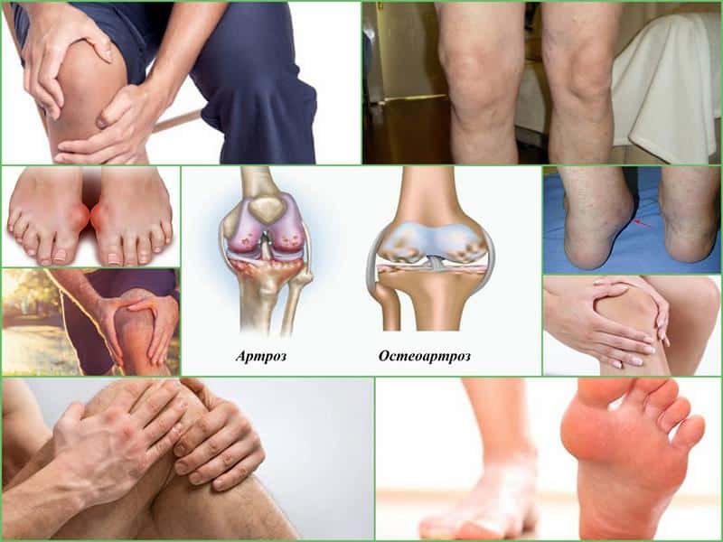 В чем разница артрита и артроза