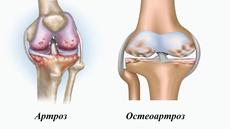 В чем разница артрита и артроза
