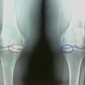 В чем разница артрита и артроза