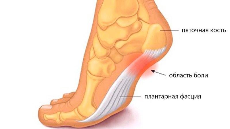 Что такое апоневроз и как его лечить