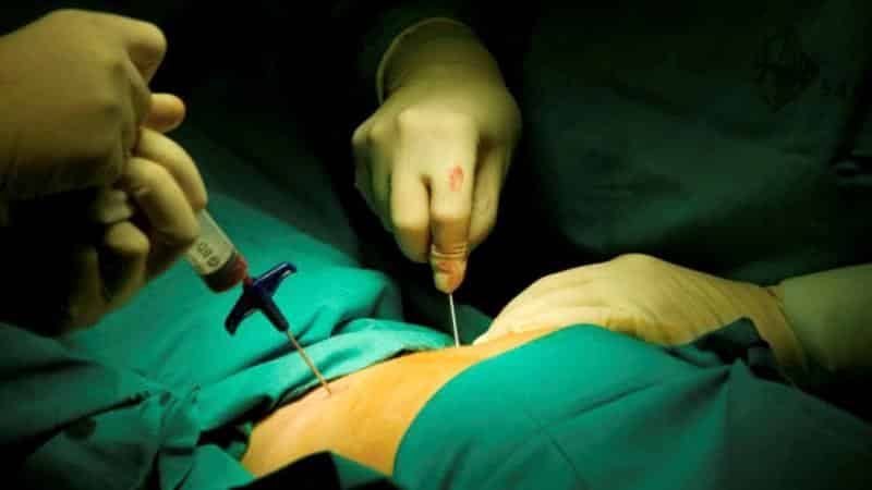 Как берут пункцию костного мозга