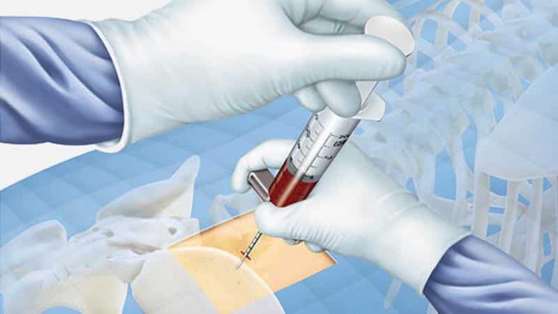 Как берут пункцию костного мозга