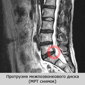Что такое диффузная протрузия дисков позвоночника