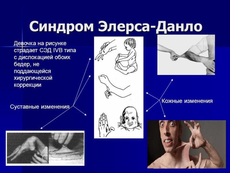 Как лечить синдром Элерса-Данлоса