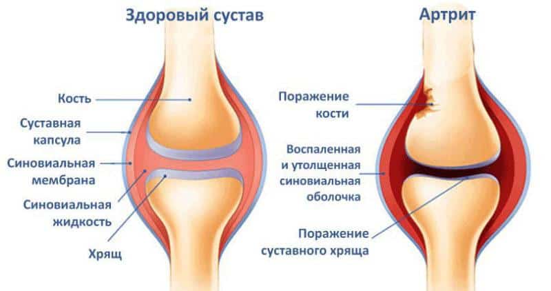 Что делать, когда болят колени при ходьбе и беге