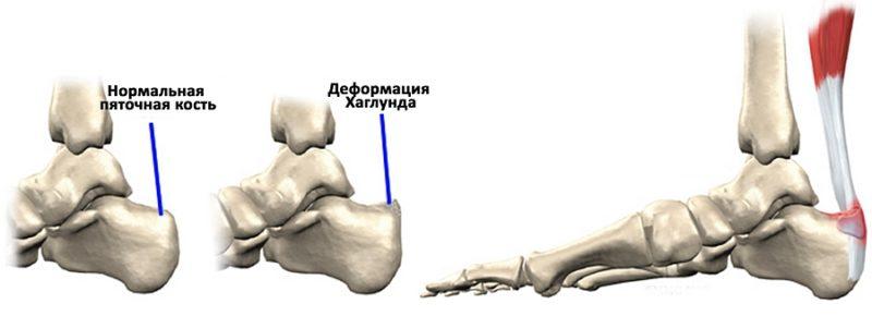 Как лечить деформацию Хаглунда