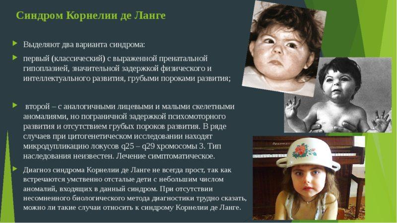 Как лечить синдром Корнелии де Ланге