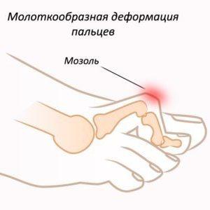 Как лечат молоткообразные пальцы на ногах