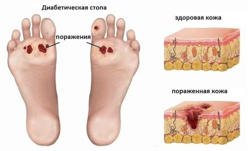 Как лечить диабетическую стопу