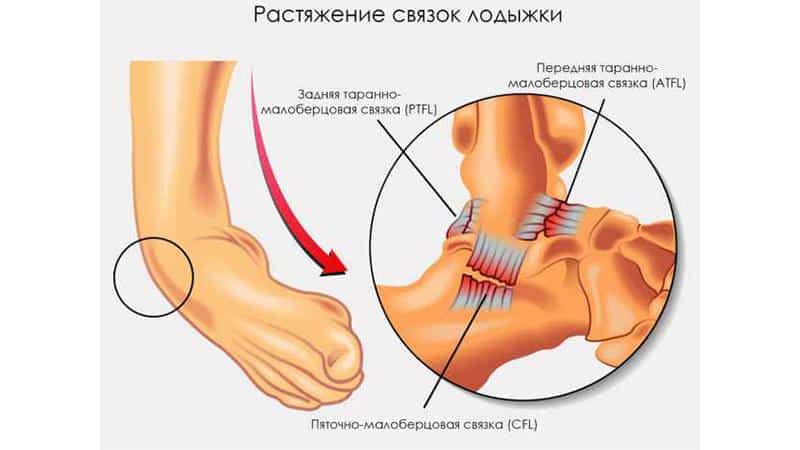 Что делать, если болит голеностопный сустав