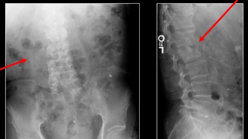 Как лечить воспаление позвоночника