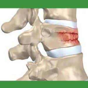 Как лечить повреждение спинного мозга