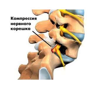 Как лечить вертеброгенный болевой синдром