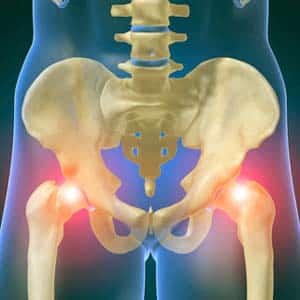 Как лечить коксартроз тазобедренных суставов