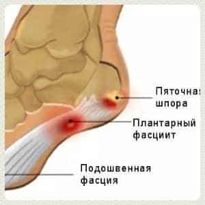 Чем мазать шпору на пятке