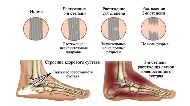 Как лечат растяжение связок