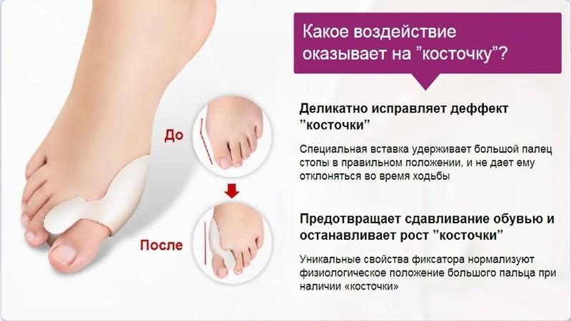 Насколько эффективен фиксатор для большого пальца Valgus Pro