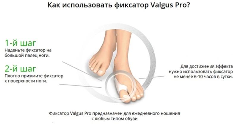 Насколько эффективен фиксатор для большого пальца Valgus Pro